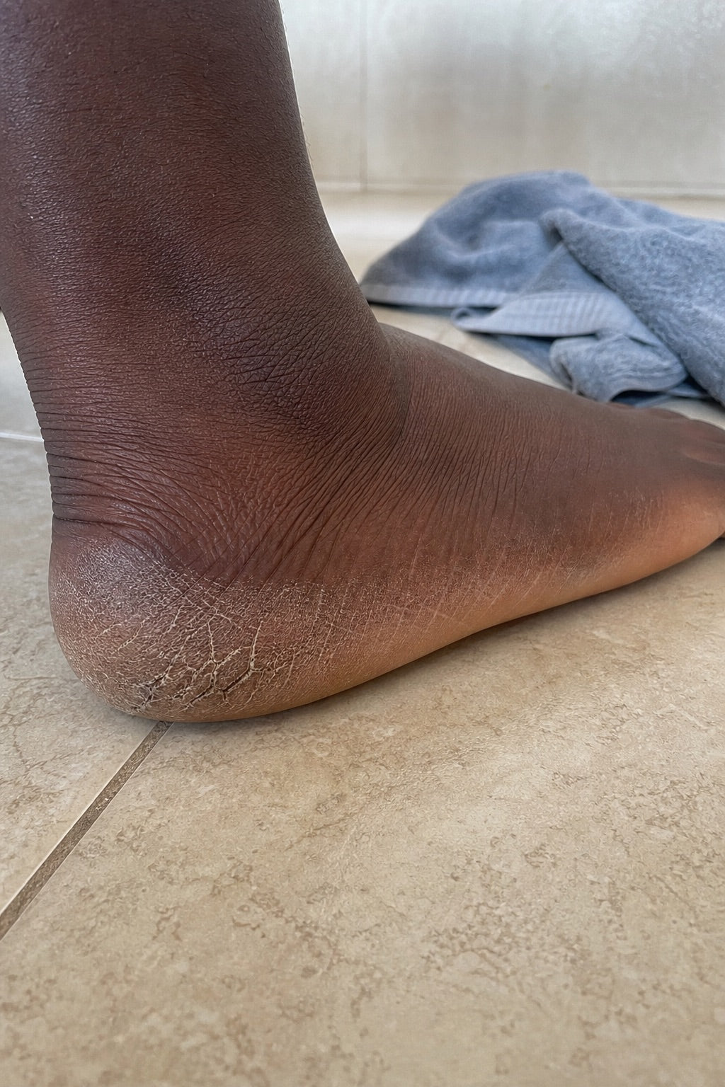 Cracked, dry heel before the soaks, day 0