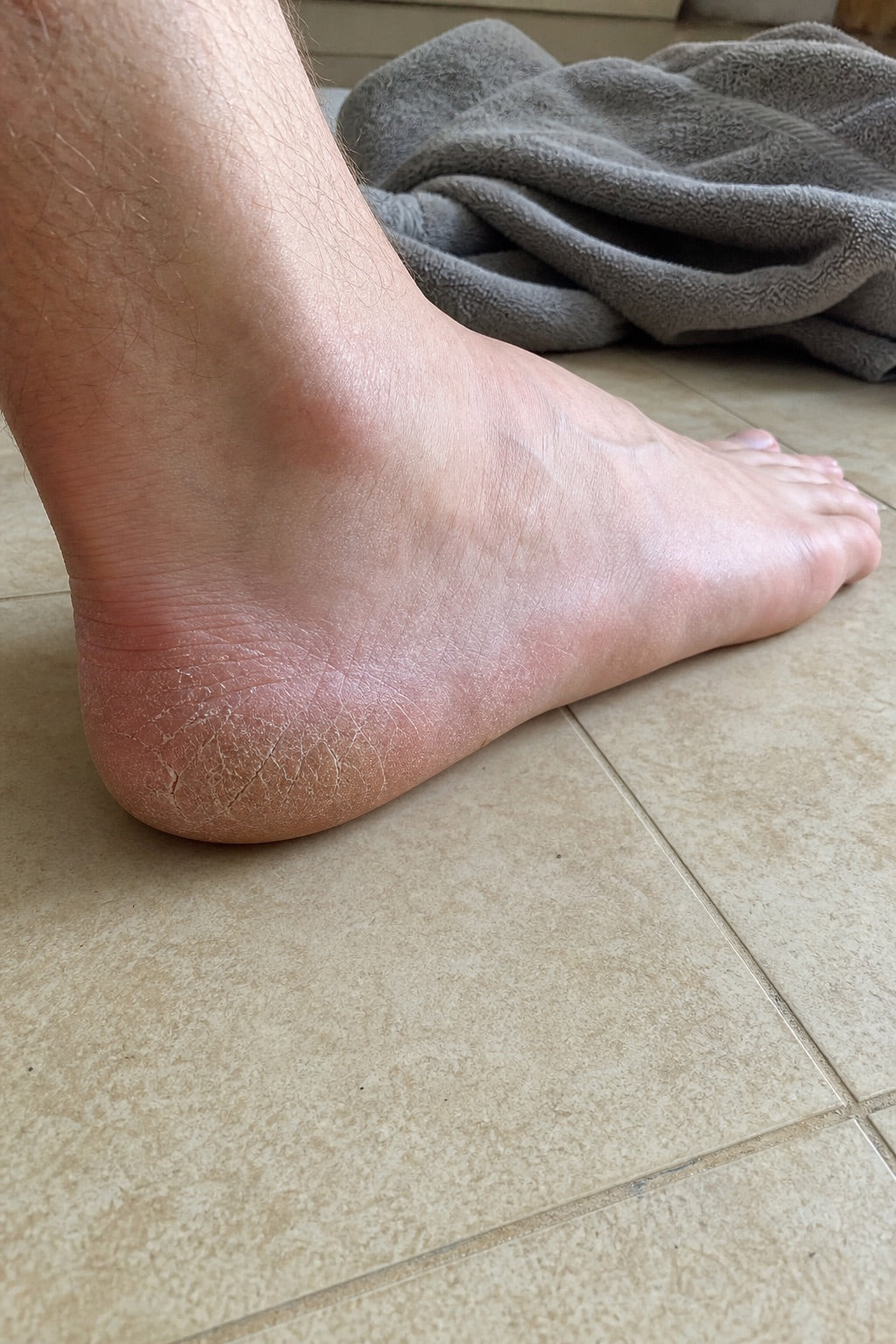 Cracked, dry heel before the soaks, day 0