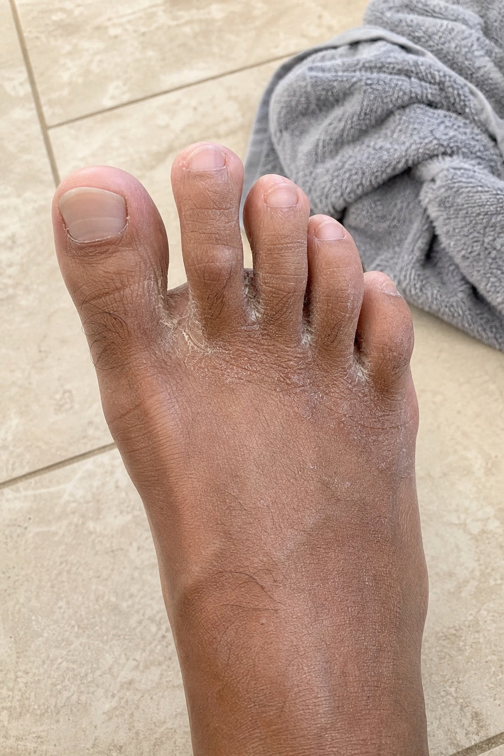 Cracked, dry skin between the toes before the soaks, day 0