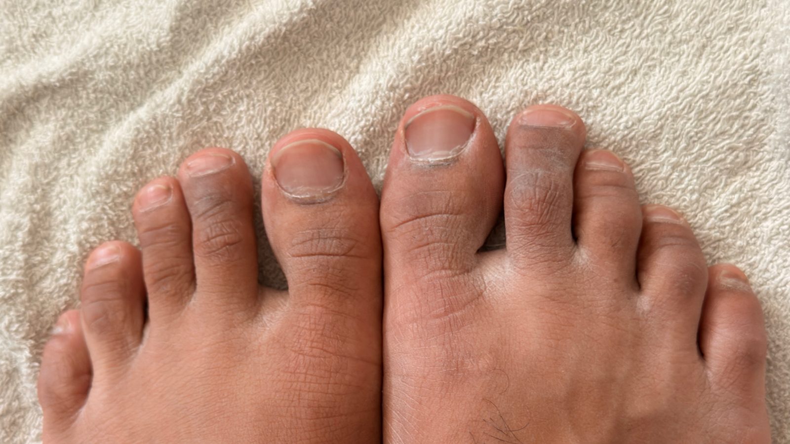 Real feet before the peel, dry and ashy, unretouched